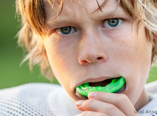 types_of_sports_mouthguards